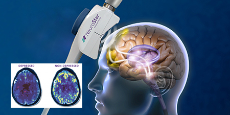 Step3_news TMS Therapy